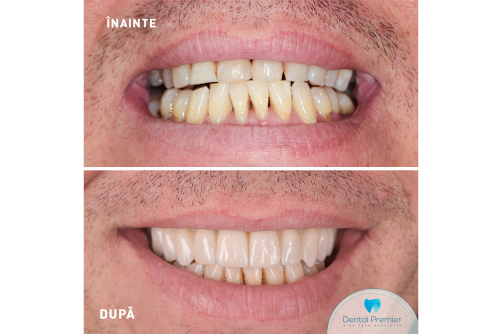 Reabilitarea orală totală, la Dental Premier în București – când este recomandată? Află totul aici